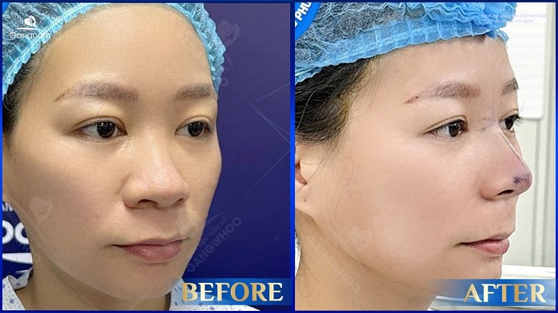 Ngoáy mũi nhiều có bị to mũi không? 8 Ngoáy mũi nhiều có bị to mũi không?