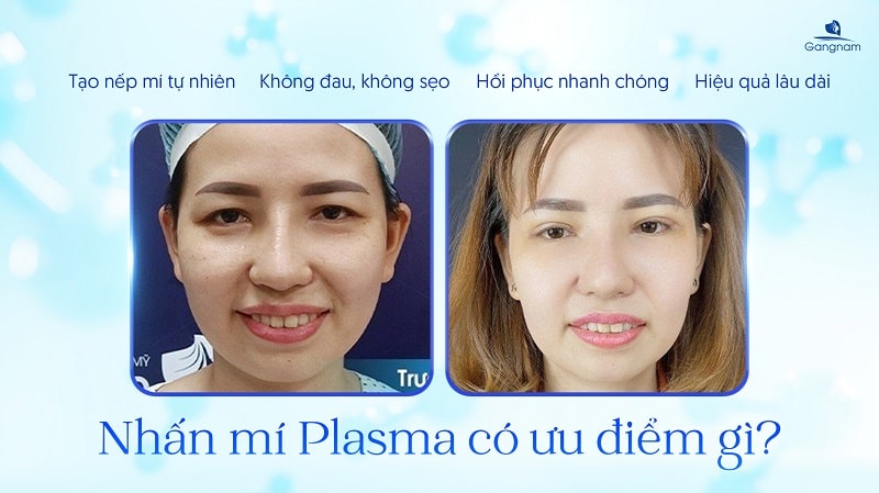 Nhấn mí Plasma là gì? Có tốt không? 6 Nhấn mí Plasma là gì?