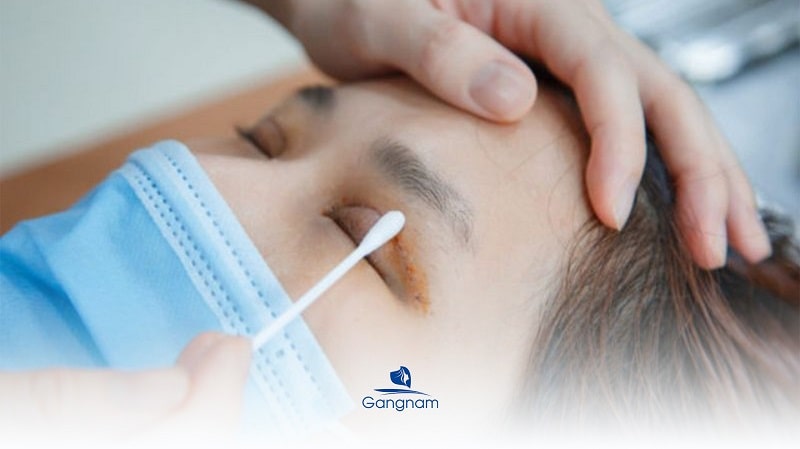 Nhấn mí Plasma là gì? Có tốt không? 7 Nhấn mí Plasma là gì?
