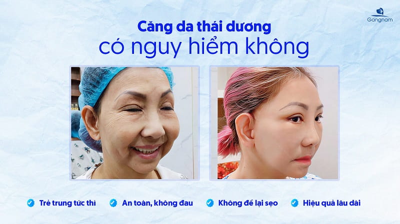 Căng da thái dương có nguy hiểm không? 5 Căng da thái dương