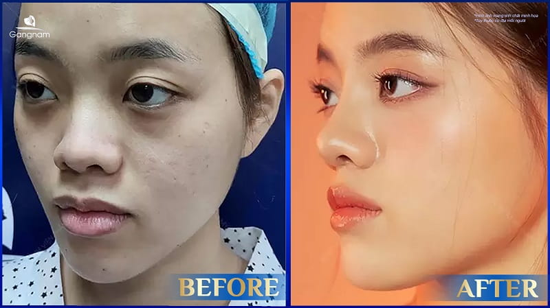 Nâng mũi ăn khổ qua được không? 8 Nâng mũi ăn khổ qua được không?
