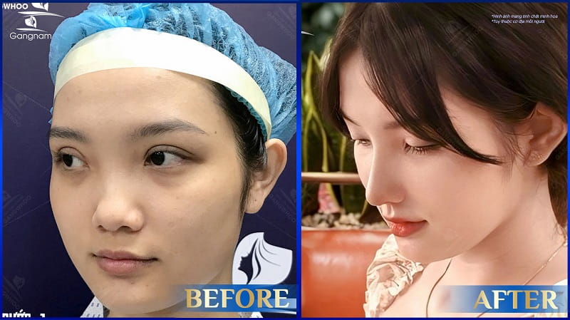 Nâng mũi xong bị nghẹt mũi phải làm sao? 6 Nâng mũi xong bị nghẹt mũi