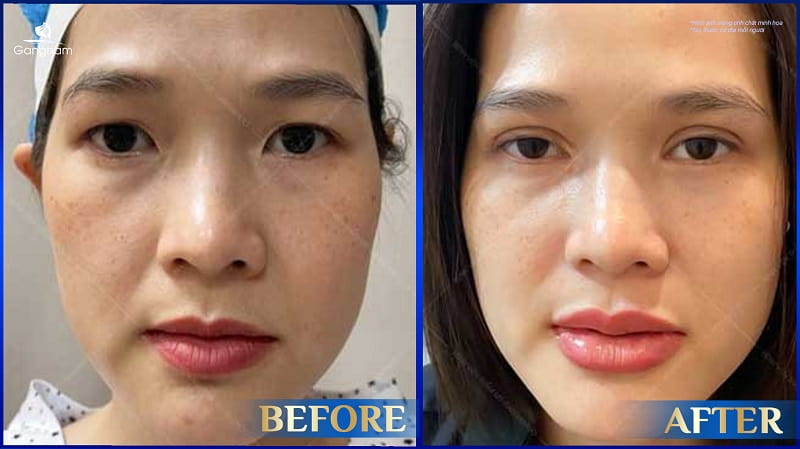 Nếp mí rẻ quạt là gì? Đẹp hay xấu? 6 Nếp mí rẻ quạt là gì?
