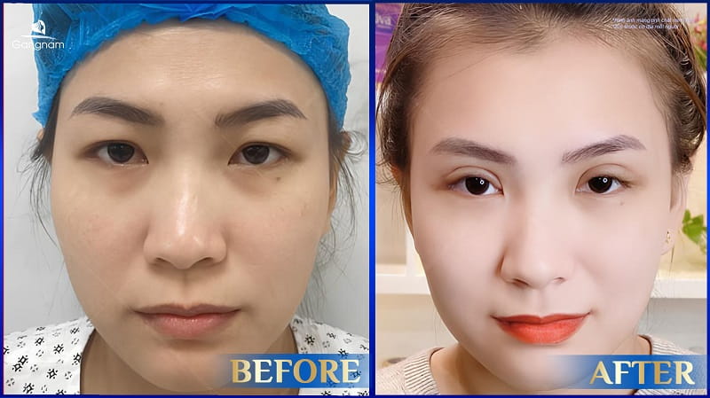 Nhấn mí bằng Laser là gì? Có tốt không? 6 Nhấn mí bằng Laser là gì?