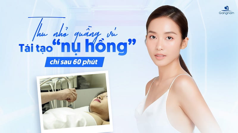 Thu nhỏ quầng vú - Tái tạo "nụ hồng" chỉ sau 60 phút 4 Thu nhỏ quầng vú