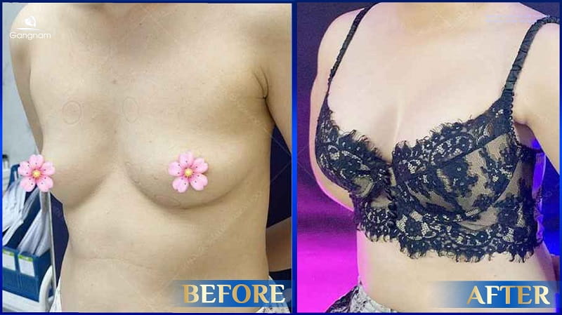 Khe ngực rộng - Nguyên nhân và cách khắc phục hiệu quả 8 Khe ngực rộng