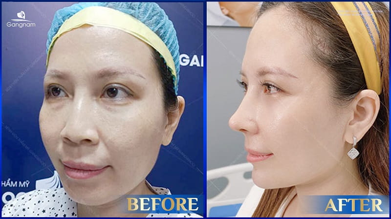 Cằm vuông là gì? Có ý nghĩa tướng số như thế nào? 8 Cằm vuông là gì?