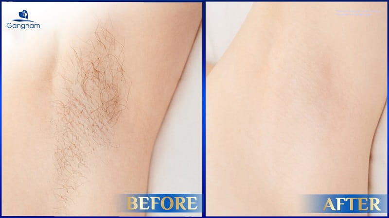 Hướng dẫn cách chăm sóc da sau triệt lông 8 Chăm sóc da sau triệt lông