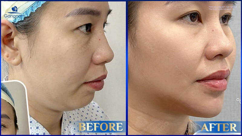 Độn cằm bằng mỡ tự thân là gì? Duy trì được bao lâu? 6 Độn cằm bằng mỡ tự thân
