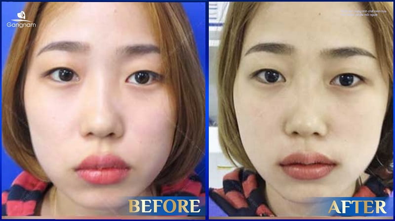 Giải mã tướng số môi trên dày hơn môi dưới 8 Môi trên dày hơn môi dưới