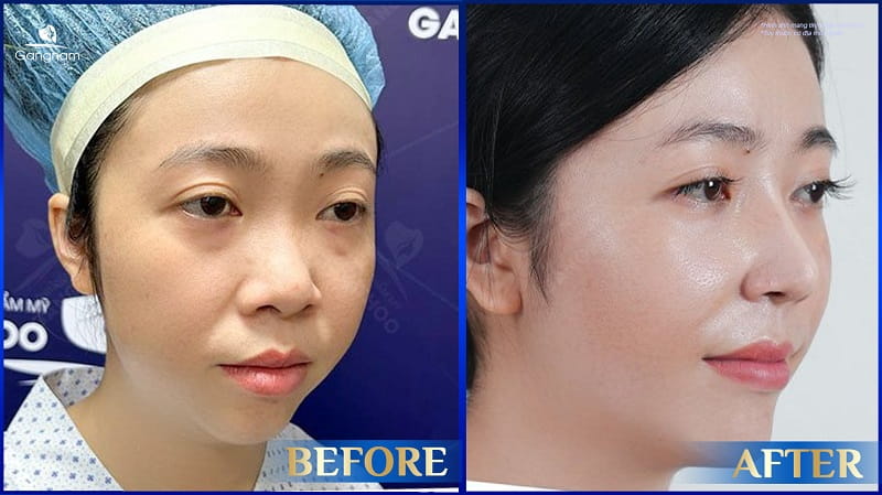 Nâng mũi bao lâu được bôi kem chống nắng? 8 Nâng mũi bao lâu được bôi kem chống nắng?