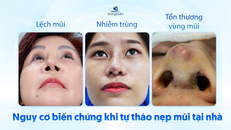 Nâng mũi tháo nẹp sớm có sao không? 6 Nâng mũi tháo nẹp sớm có sao không?