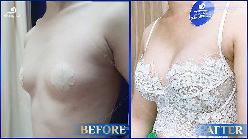 Túi ngực Motiva có tốt không? 9 Nâng ngực bao lâu thì được tắm?