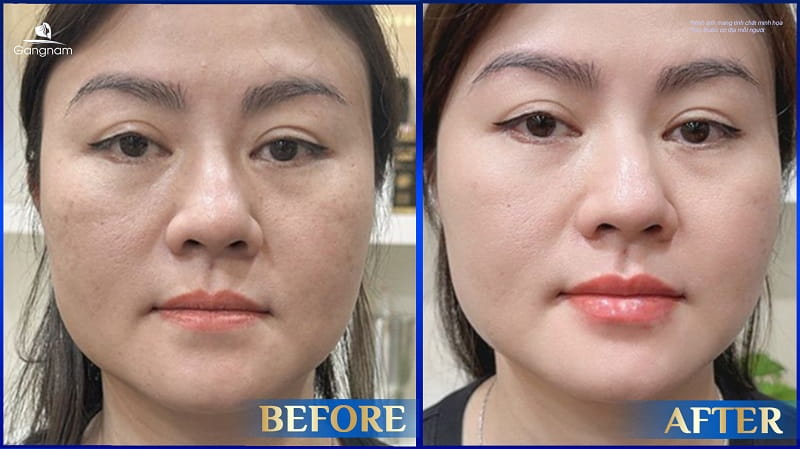Tiêm filler nhiều lần có hại không? 8 Tiêm filler nhiều lần có hại không?