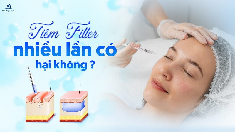 Tiêm filler nhiều lần có hại không? 5 Tiêm filler nhiều lần có hại không?