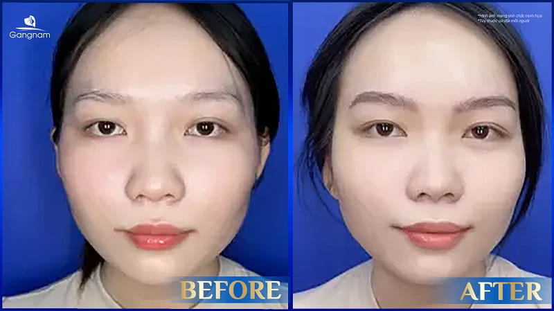 Lông mày giao nhau là gì? Tướng tốt hay xấu? Cách khắc phục hiệu quả 8 Lông mày giao nhau