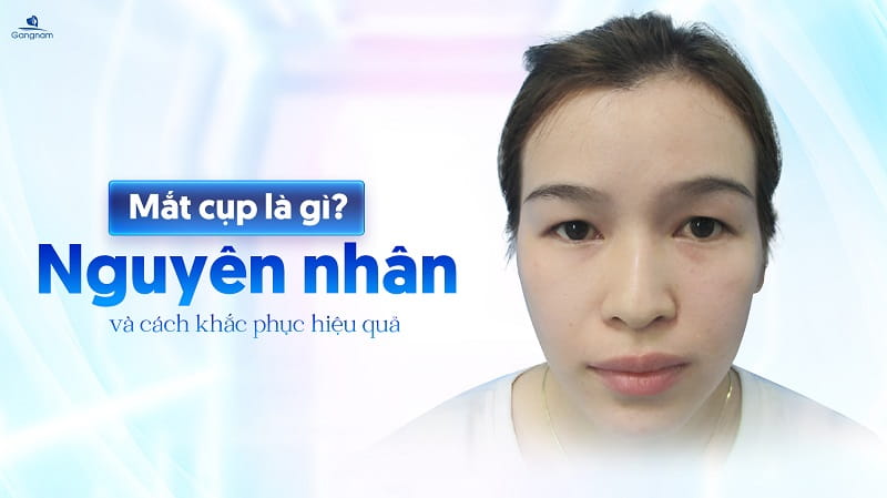 Mắt cụp là gì? Nguyên nhân và cách khắc phục hiệu quả 5 Mắt cụp là gì?