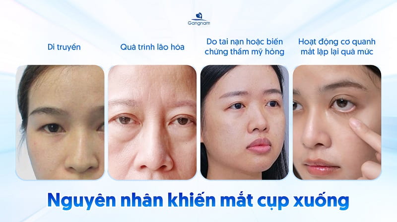 Mắt cụp là gì? Nguyên nhân và cách khắc phục hiệu quả 6 Mắt cụp là gì?