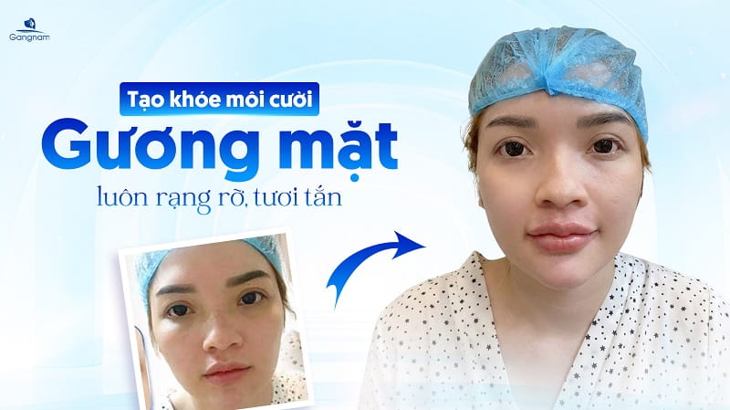 Môi thuyền úp là gì? Tướng tốt hay xấu? 6 Môi thuyền úp là gì?