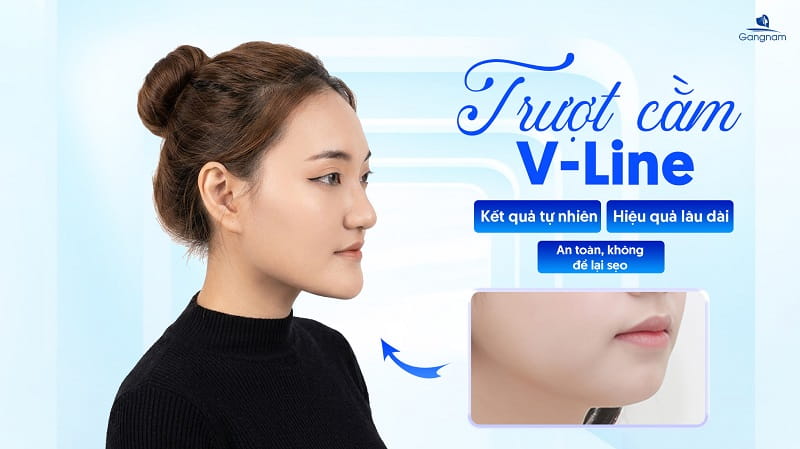 Phẫu thuật trượt cằm: Ưu điểm, đối tượng và những lưu ý quan trọng 6 Phẫu thuật trượt cằm