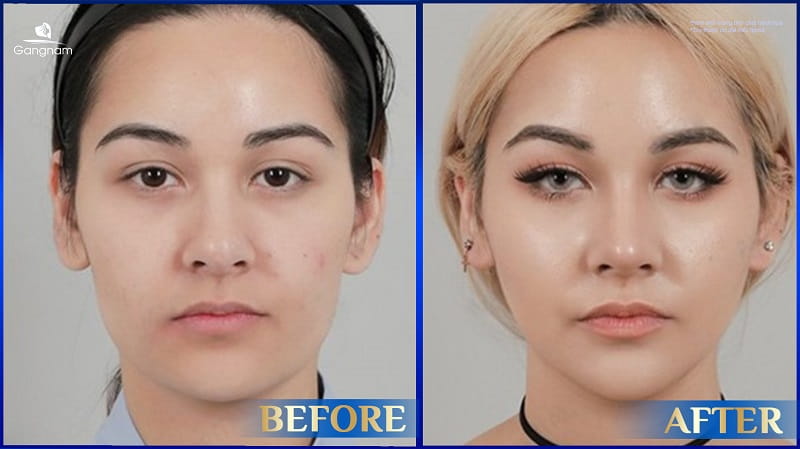 Phẫu thuật trượt cằm: Ưu điểm, đối tượng và những lưu ý quan trọng 8 Phẫu thuật trượt cằm