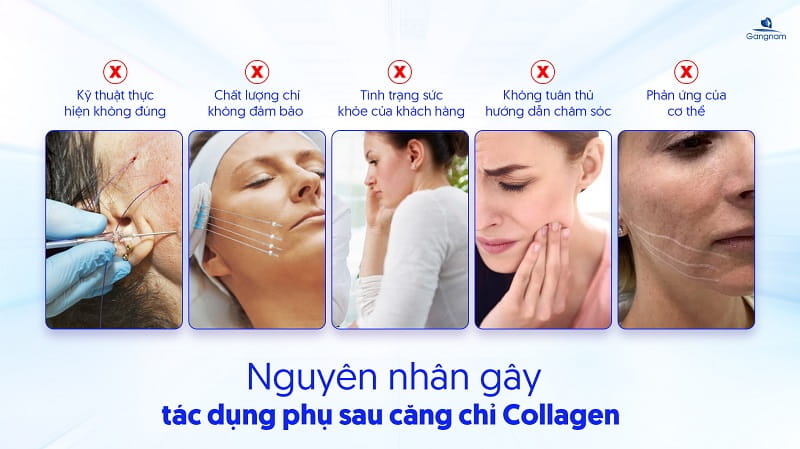 Căng chỉ Collagen có tác dụng phụ không? 5 Căng chỉ Collagen có tác dụng phụ không?
