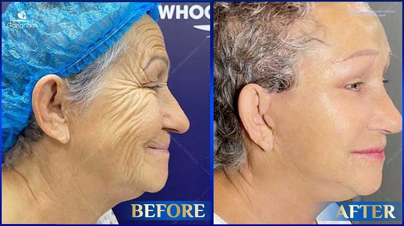 Căng chỉ Collagen có tác dụng phụ không? 6 Căng chỉ Collagen có tác dụng phụ không?