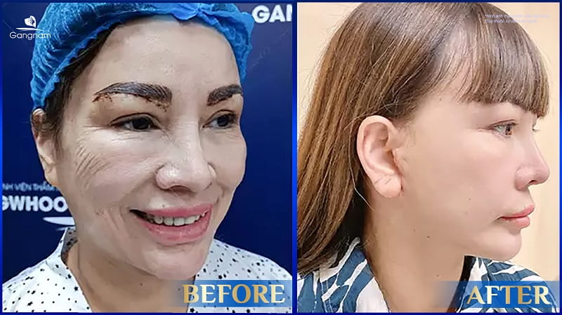 Căng da mặt Deep Plane - Giải pháp trẻ hóa chuyên sâu 8 Căng da mặt Deep Plane