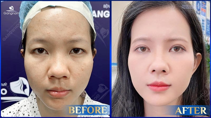 Phẫu thuật Midface - Công nghệ trẻ hóa tầng giữa mặt 10 Cắt mí có làm mắt to hơn không?