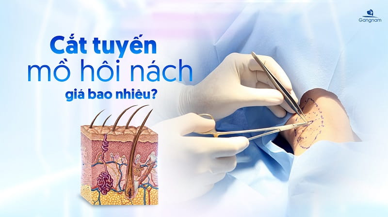 Cắt tuyến mồ hôi nách giá bao nhiêu? 4 Cắt tuyến mồ hôi nách giá bao nhiêu?