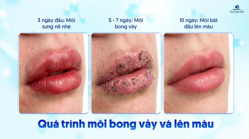 Khử thâm môi bao lâu lên màu? 5 Khử thâm môi bao lâu lên màu?