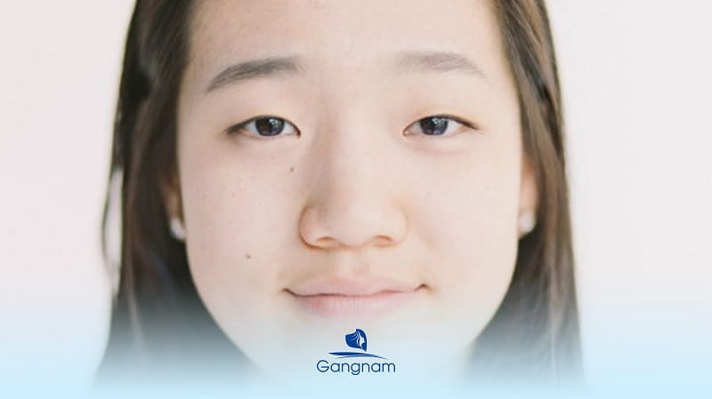 Mắt xa nhau là gì? Tướng số của người có khoảng cách 2 mắt xa nhau 5 Mắt xa nhau là gì?