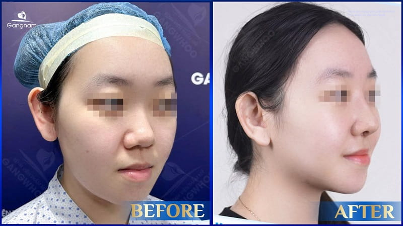 Sụn Softxil là gì? Nâng mũi sụn Softxil giá bao nhiêu? 8 Sụn Softxil là gì?