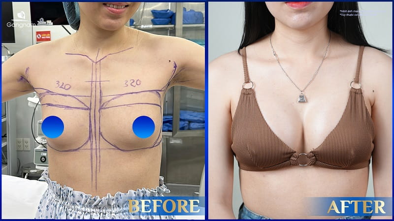 Thông khe ngực là gì? Nguyên nhân và cách khắc phục hiệu quả 7 Thông khe ngực là gì?