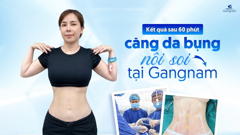 Phẫu thuật căng da bụng là gì? Đối tượng chỉ định và chống chỉ định căng da bụng 6 Căng da bụng