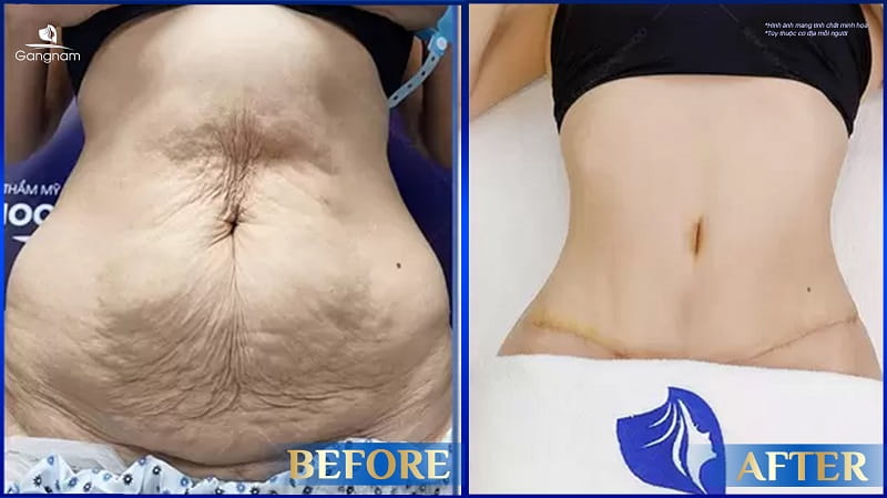 Phẫu thuật căng da bụng là gì? Đối tượng chỉ định và chống chỉ định căng da bụng 8 Căng da bụng