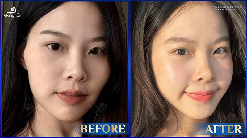 Gò má thấp là gì? Nguyên nhân và cách khắc phục hiệu quả 8 Gò má thấp là gì?