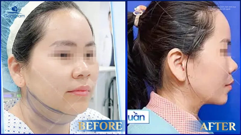 Hút mỡ nọng cằm là gì? Những điều cần lưu ý khi hút mỡ nọng cằm 5 Hút mỡ nọng cằm