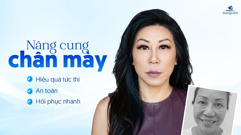 Nâng cung chân mày bằng chỉ - Giải pháp trẻ hóa đôi mắt không xâm lấn 6 Nâng cung chân mày bằng chỉ