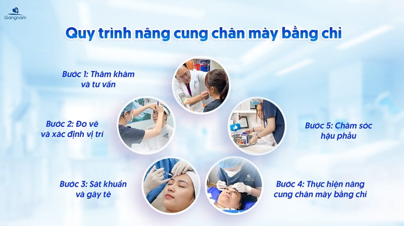 Nâng cung chân mày bằng chỉ - Giải pháp trẻ hóa đôi mắt không xâm lấn 7 Nâng cung chân mày bằng chỉ