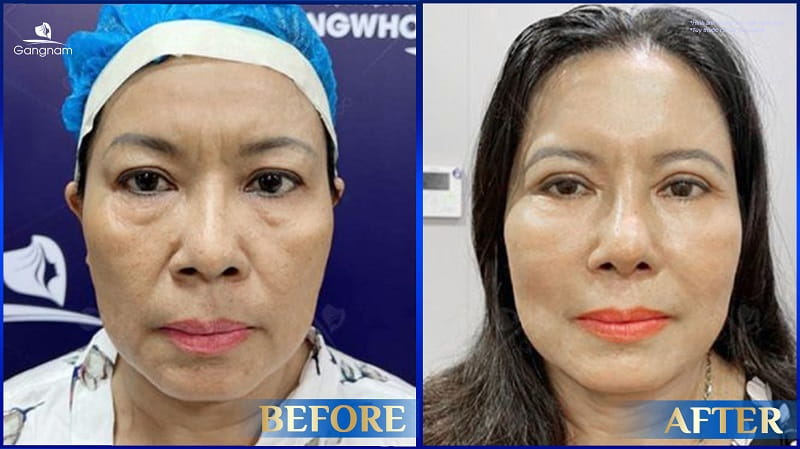 Nâng cung chân mày bằng chỉ - Giải pháp trẻ hóa đôi mắt không xâm lấn 8 Nâng cung chân mày bằng chỉ