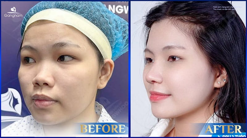 Nâng mũi bằng mỡ trung bì là gì? Giá bao nhiêu? 8 Nâng mũi bằng mỡ trung bì