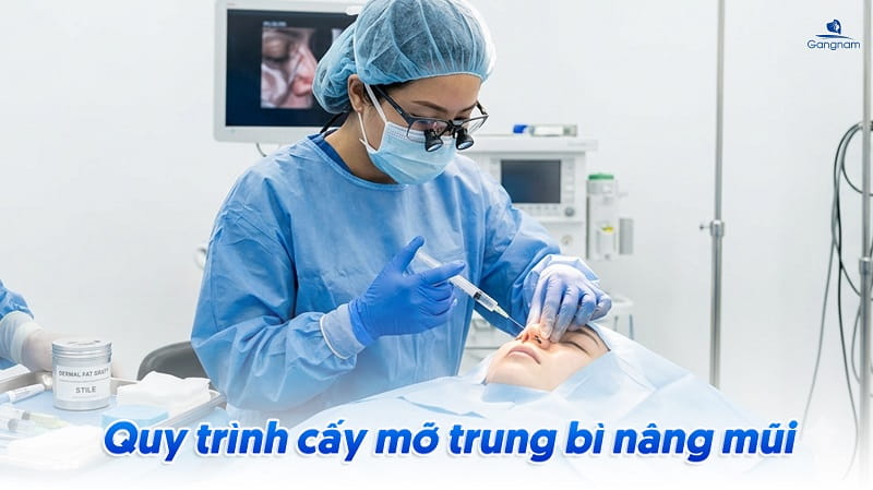 Nâng mũi bằng mỡ trung bì là gì? Giá bao nhiêu? 7 Nâng mũi bằng mỡ trung bì