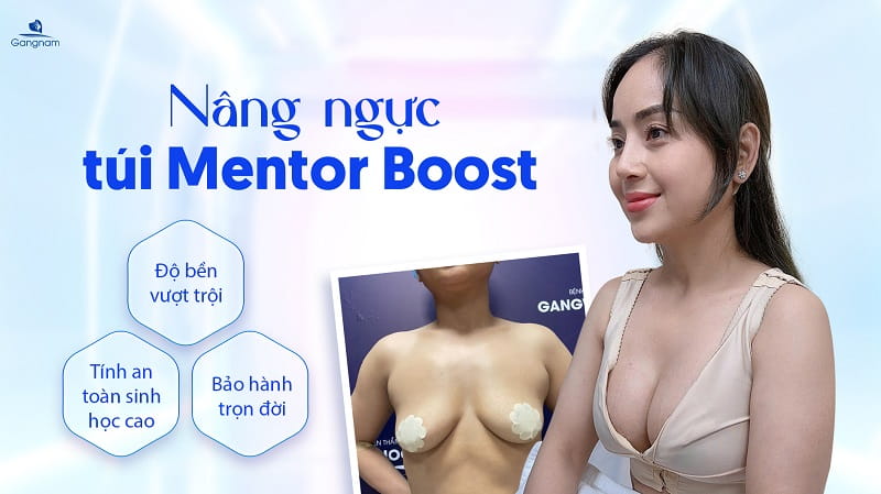 Nâng ngực túi Mentor Boost giá bao nhiêu? 7 Nâng ngực túi Mentor Boost