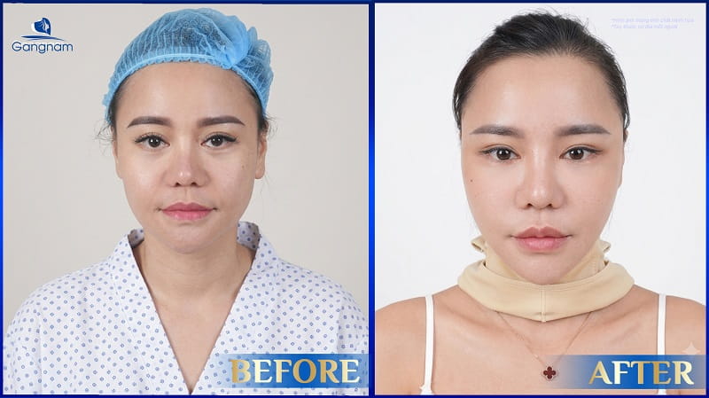 Phẫu thuật Midface - Công nghệ trẻ hóa tầng giữa mặt 9 Phẫu thuật Midface