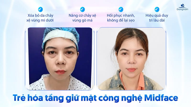 Phẫu thuật Midface - Công nghệ trẻ hóa tầng giữa mặt 7 Phẫu thuật Midface