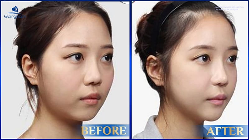 Trán bị lõm là gì? Nguyên nhân và cách khắc phục trán lõm hiệu quả 8 Trán bị lõm là gì?