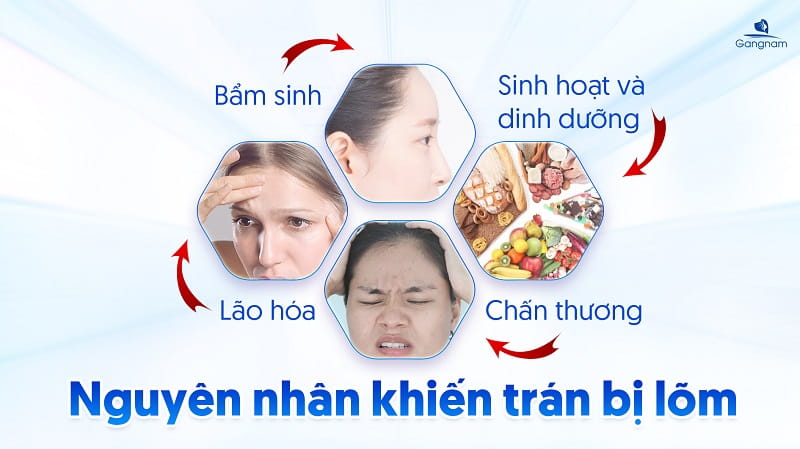 Trán bị lõm là gì? Nguyên nhân và cách khắc phục trán lõm hiệu quả 6 Trán bị lõm là gì?
