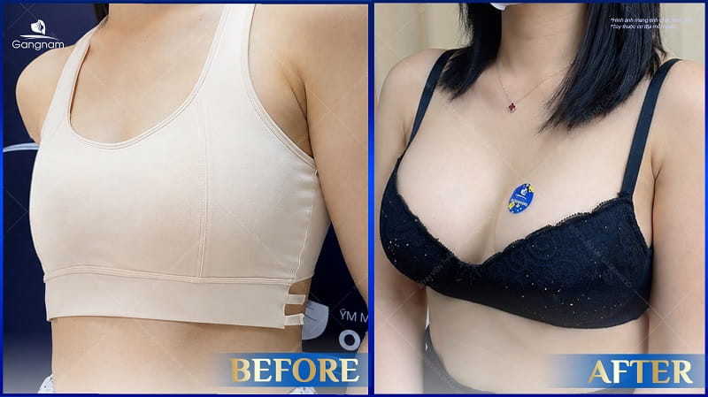 Vỡ túi ngực - Dấu hiệu nhận biết và giải pháp phòng tránh 10 Vỡ túi ngực