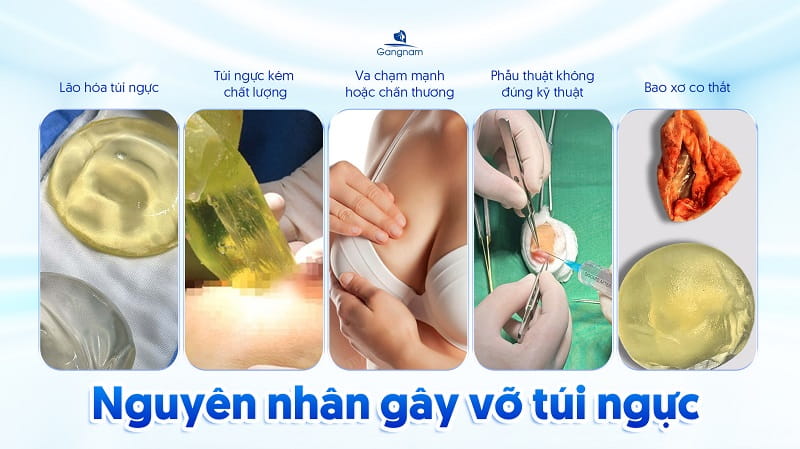 Vỡ túi ngực - Dấu hiệu nhận biết và giải pháp phòng tránh 7 Vỡ túi ngực
